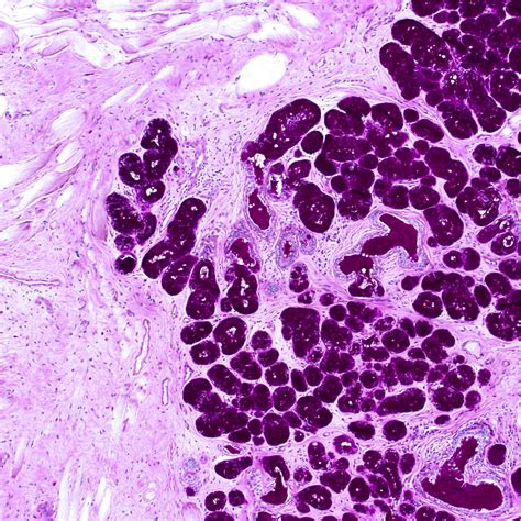 Pathology Outlines - Cowper glands