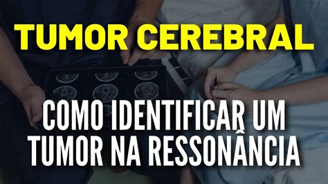 Tumor Cerebral Como Identificar um Tumor na Ressonância