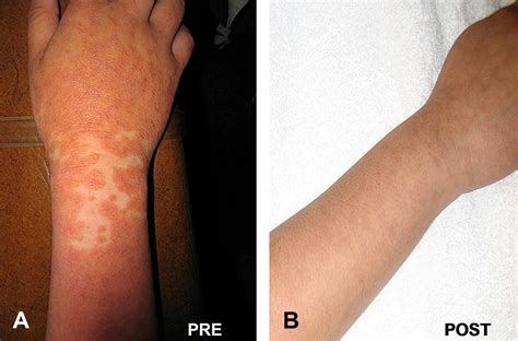 Treatment Of Juvenile Pityriasis Rubra Pilaris With Etanercept