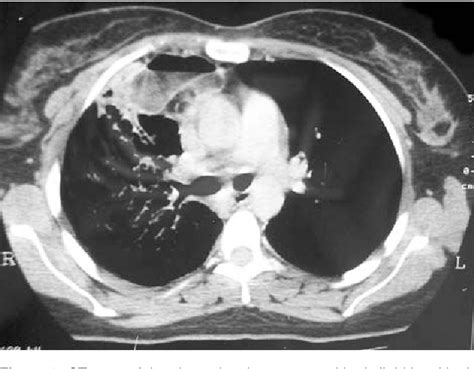 Figure 2 From Mediastinal Teratoma With Spontaneous Rupture Into The