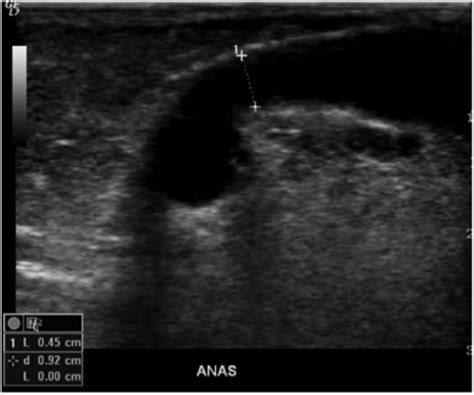 Dialysis Graft Ultrasound