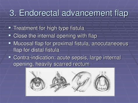 PPT Treatment For Anal Fistula PowerPoint Presentation ID