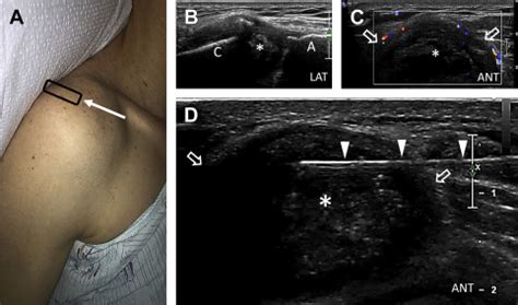 Shoulder Ultrasound Technique