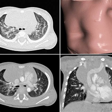 Thoracic Hrct Imaging With Contrast Medium A Axial View Pulmonary