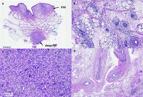 Pathology: a Fibrous hamartoma of the infancy involving skin, dermis ...