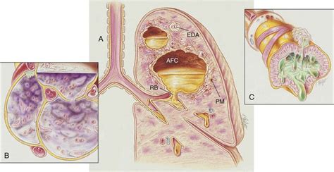 Lung Abscess | Thoracic Key