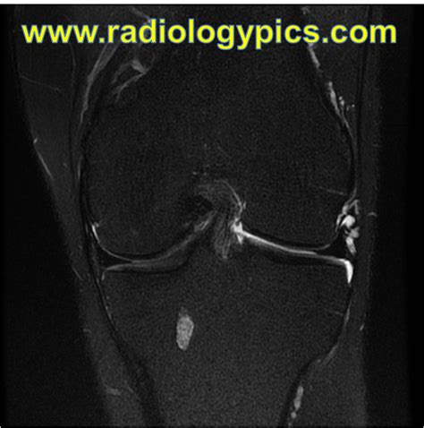 Unknown Case 29 Knee Mri Radiologypicscom