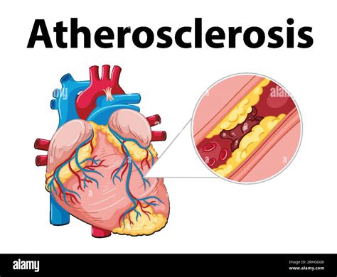 Atherosclerosis development hi-res stock photography and images - Alamy
