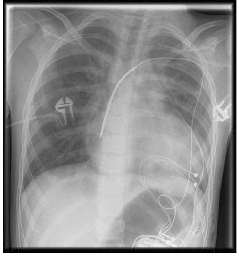 Anteroposterior Chest Radiography Showing The Position Of The Implanted