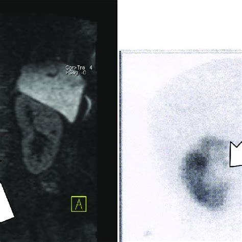 7. Diuretic renogram with MAG3 demonstrating flat drainage after... | Download Scientific Diagram