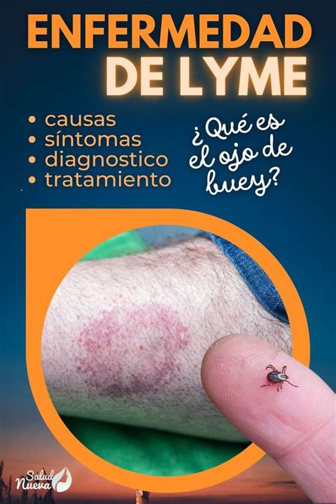 Enfermedad De Lyme S Ntomas Y Tratamiento