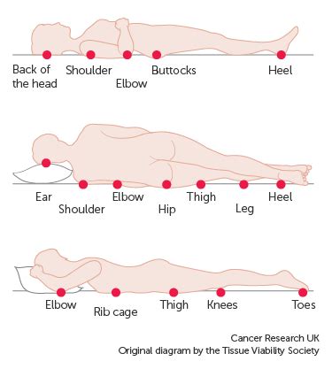 Causes and prevention of pressure sores – Artofit