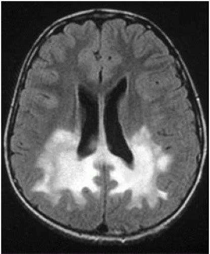 Leukodystrophies Radiology Key