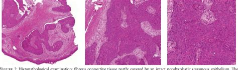 Figure From Isolated Nasal Tip Metastasis From Esophageal Squamous