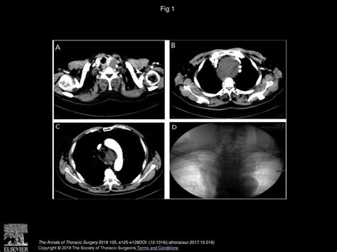 Urgent Surgical Approach To Mediastinal Cyst Causing Life Threatening