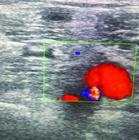 Duplex venous study showing cross section of popliteal vein absence of ...