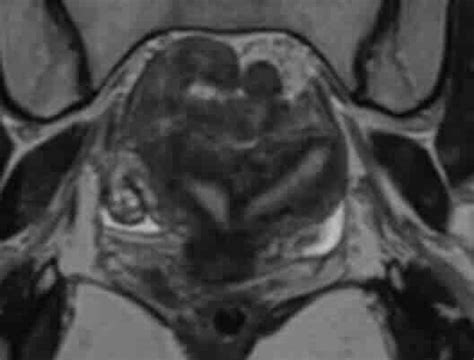 uterus ve rahim hastaliklari opdr erdal seker kadin hastaliklari
