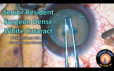 Resident Surgeon Takes On A Dense White Cataract Cataract Coach™