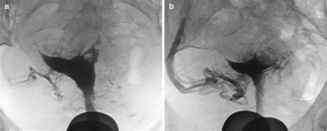 Retroverted Uterus Hsg