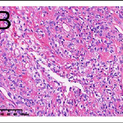 Morphological Findings Of The Solitary Fibrous Tumor Hemangiopericytoma