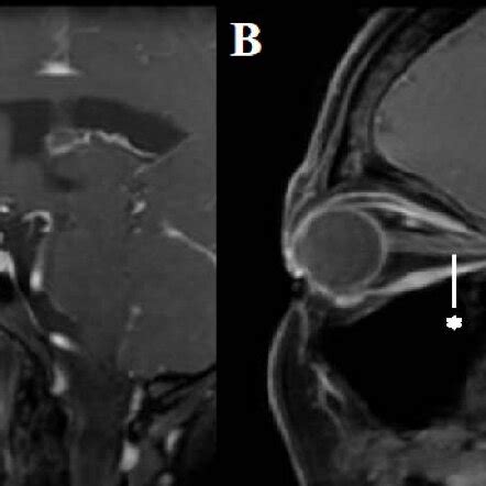 Right Eye A And Left Eye B Sagittal Views Of Orbit MRI With