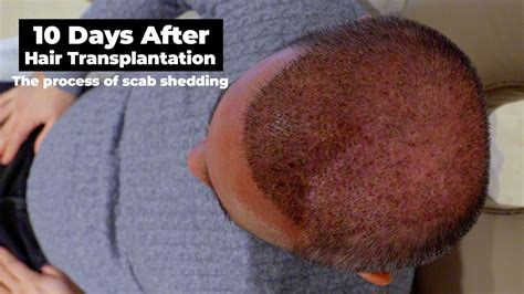 Hair Transplant The Process Of Scab Shedding Youtube