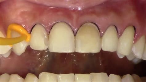 The 1 Step Double Cord Technique For Porcelain Veneers Dr Andre Reis