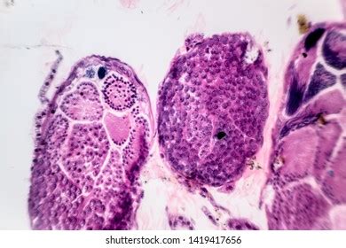 Histology Duodenal Biopsy Patient Bloating Diarrhea