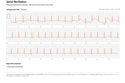 Do I have AFib? : ReadMyECG