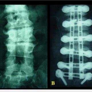 X Ray Of The Lumbar Spine Ap View That Shows A Levoscoliosis Of The