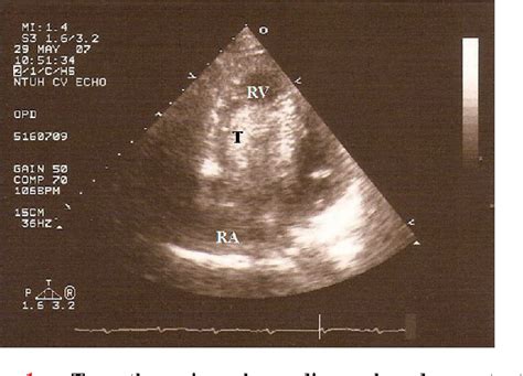 Figure From Intravenous Leiomyomatosis With Intracardiac Extension