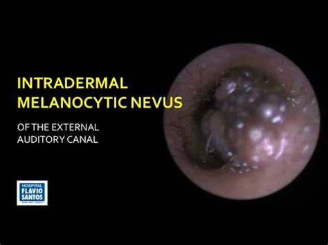 Intradermal Melanocytic Nevus Of The External Auditory Canal Youtube