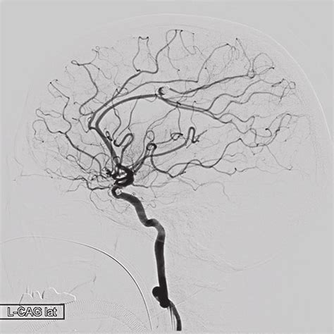 Postoperative Internal Carotid Angiograms The Lateral View Of Left