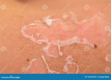 Skin peeling after sunburn stock photo. Image of care - 155379970