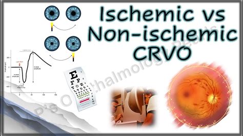 Ischemic Vs Non Ischemic CRVO YouTube