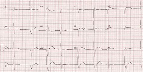 Ventricular Paced Rhythm