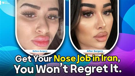 Rhinoplasty Experience In Iran From London To Tehran Youtube