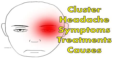 Cluster headache symptoms treatments causes – Artofit