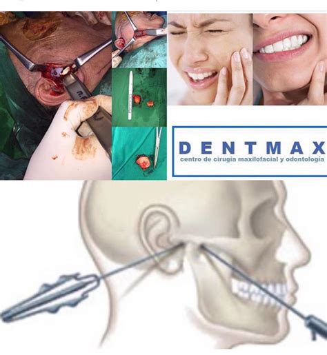 Artroscopia y Cirugía de Articulación temporomandibular ATM DENTMAX