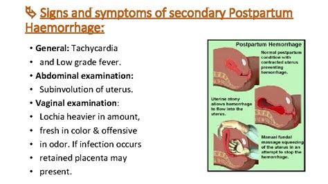 Postpartum Complications Postpartum Hemorrhage Definition It Is Defined