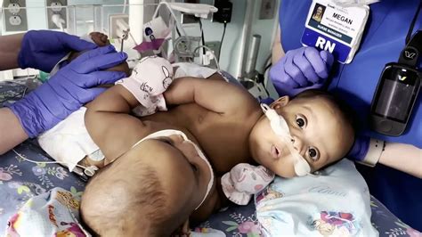 Watch Today Excerpt Conjoined Twins Successfully Separated In Rare