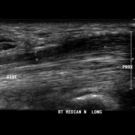 Carpal Tunnel Syndrome Ultrasound