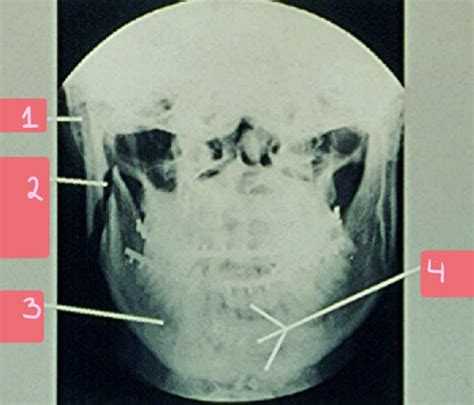 Lab Quiz 3 Mandible TMJ Anatomy Flashcards Quizlet