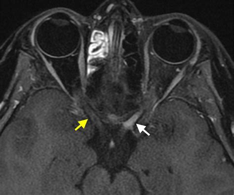 Multiple Sclerosis: Clinical Overview and Updates | Figure 1