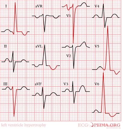 Left ventricular hypertrophy electrocardiogram - wikidoc