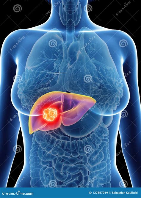 A Womans Liver Cancer Stock Illustration Illustration Of Metais 127857019