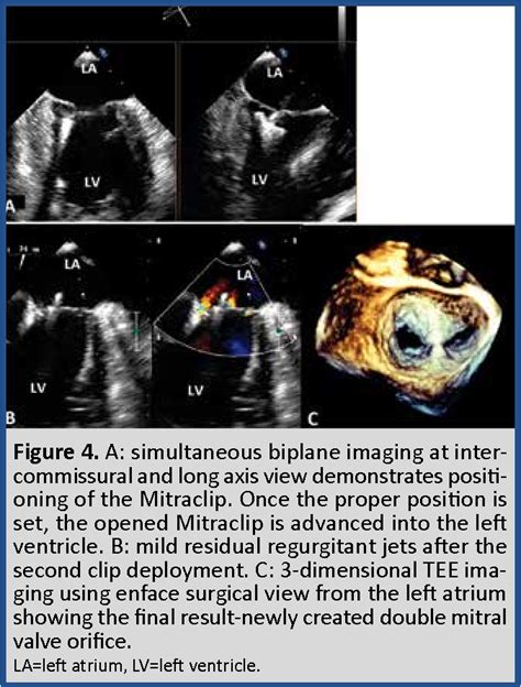 Figure 1 From Percutaneous Repair Of Mitral Regurgitation With The