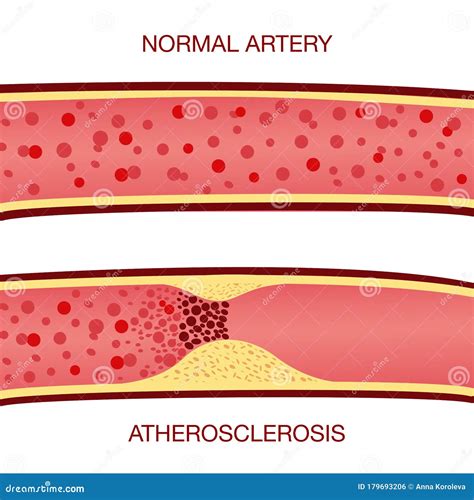 Cholesterol Plaque In Artery Atherosclerosis Illustration Stock Vector