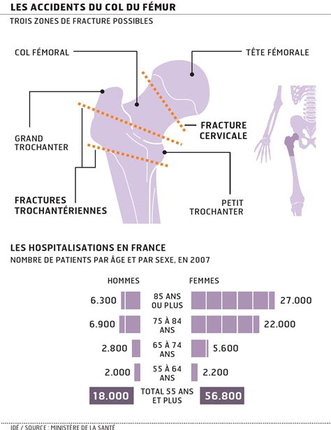 Mieux Prendre En Charge La Fracture Du Col Du Fémur