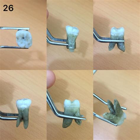 Jual GIGI MOLAR RAHANG ATAS GIGI 16 26 Indonesia Shopee Indonesia